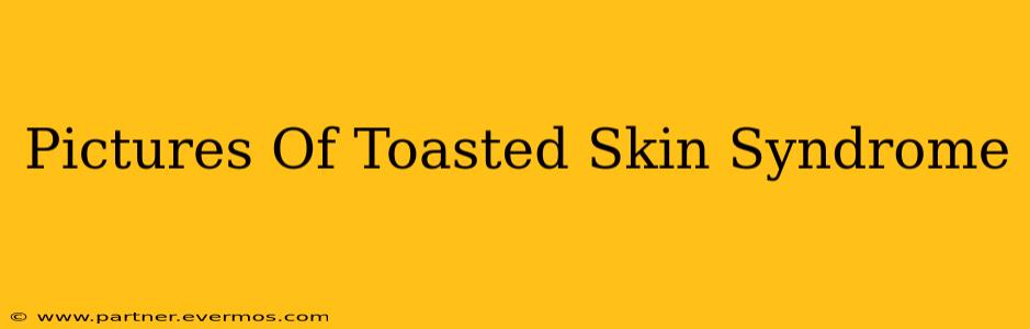 Pictures Of Toasted Skin Syndrome